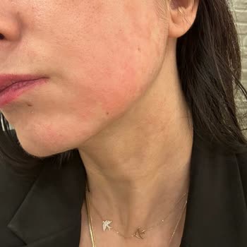 Reacción alérgica con La Roche-Posay Hyalu B5 Serum