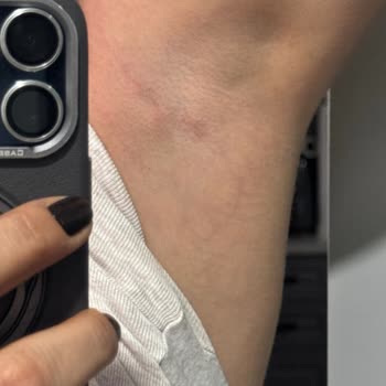 Schmerzhaft und gefährlich: Gesundheitsprobleme durch Rexona Roll-on