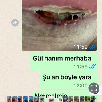 Karın Germe Ameliyatında Beklenmedik Sorunlar