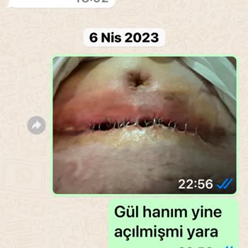 Karın Germe Ameliyatında Beklenmedik Sorunlar