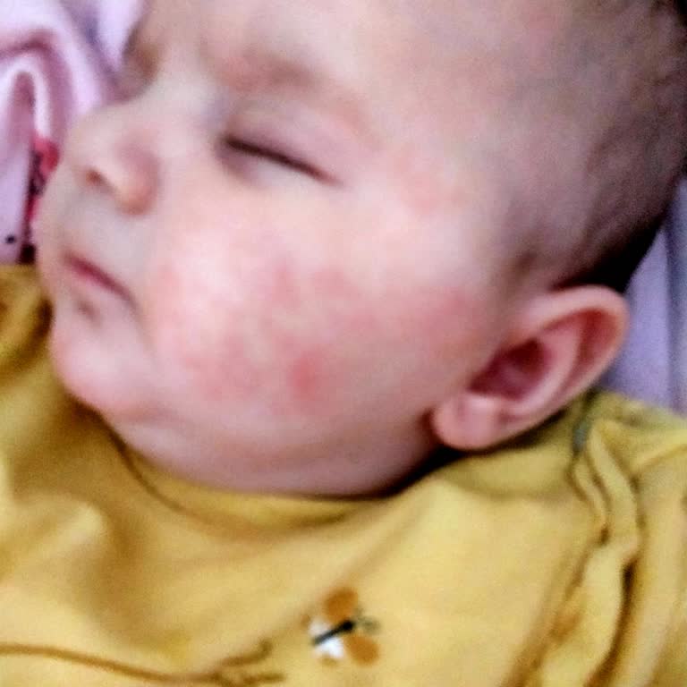 Bebeğimde Kızarıklık Yapan Ürün İçin İade Talebi