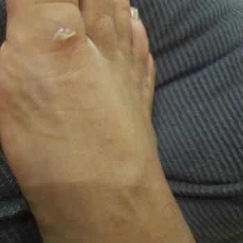 Ayakkabılarım Ayağımı Yaralıyor, İade Kabul Edilmiyor