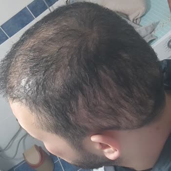 Aslı Tarcan Saç Ekimi Hayal Kırıklığı