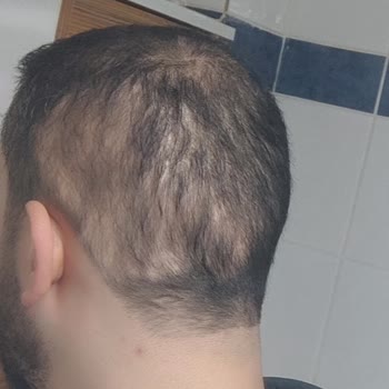 Aslı Tarcan Saç Ekimi Hayal Kırıklığı