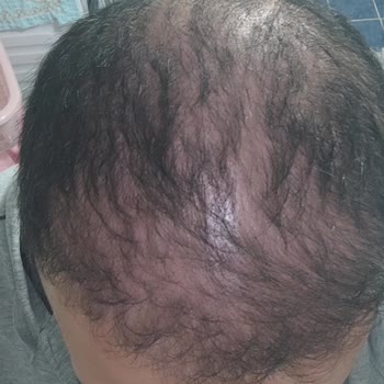 Aslı Tarcan Saç Ekimi Hayal Kırıklığı