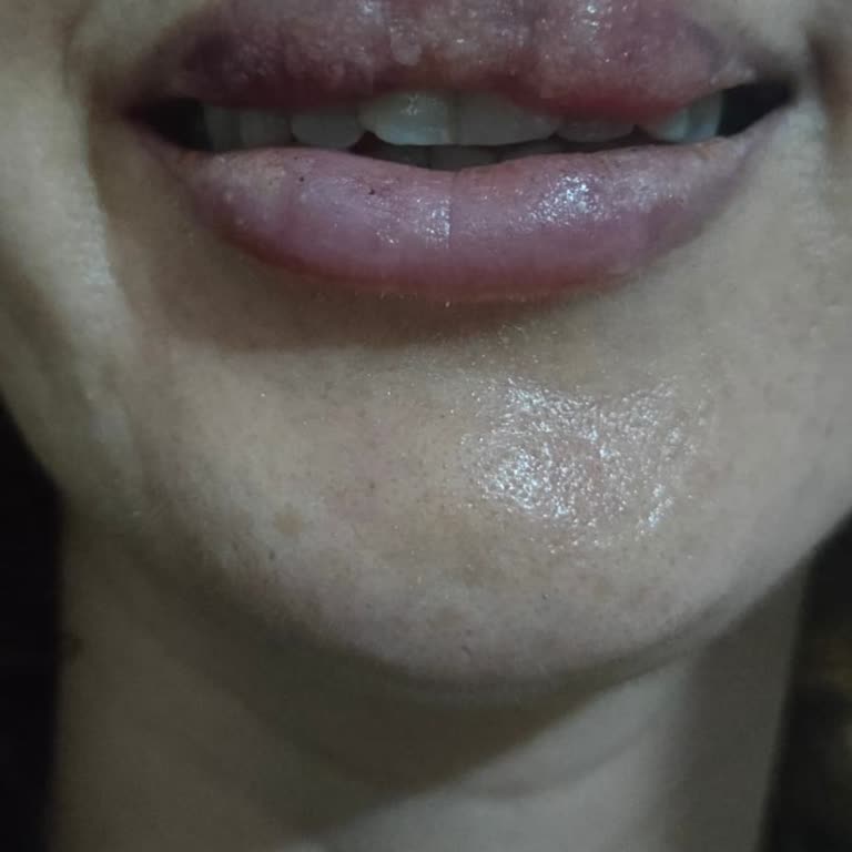 Sahte Dolgu Sonrası Hayal Kırıklığı Ve Düzeltilemeyen Hasar