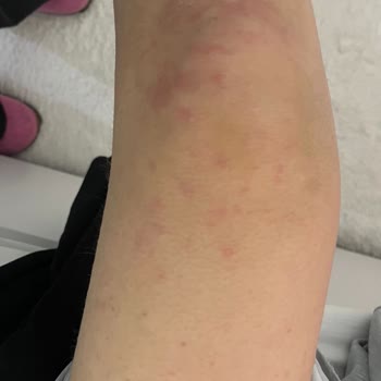 Victoria Secret Losyonları Alerji Yaptı Ve Zarar Verdi