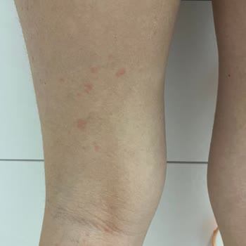 Victoria Secret Losyonları Alerji Yaptı Ve Zarar Verdi