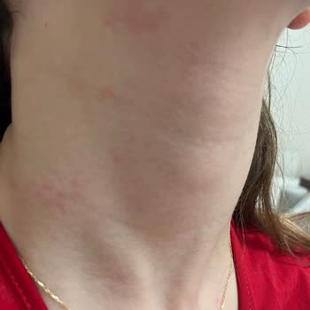 Victoria Secret Losyonları Alerji Yaptı Ve Zarar Verdi