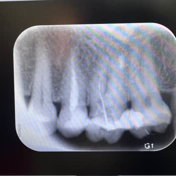 Dişhane Sağlık Grubu Diş Tedavisinde Kalan İğne Ve Yetersiz Destek