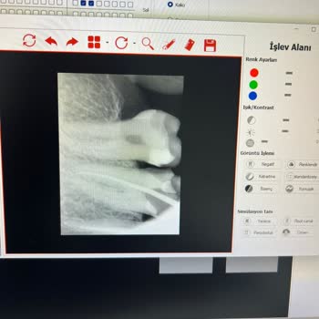 Dişhane Sağlık Grubu Diş Tedavisinde Kalan İğne Ve Yetersiz Destek