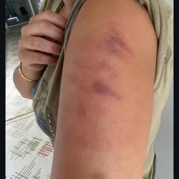 Df Chanell Güzellik Merkezi Lazerde Kollarımı Yaktılar