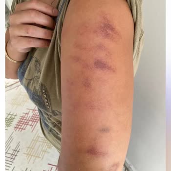 Df Chanell Güzellik Merkezi Lazerde Kollarımı Yaktılar