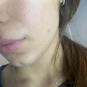 Güvenilir Markanın Nemlendiricisi Cildimi Mahvetti