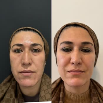 Luxen Wellness Clinic Estetik İşlemlerden Memnuniyetsizlik