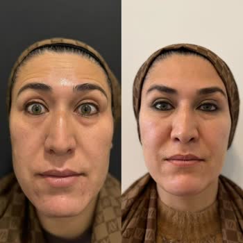 Luxen Wellness Clinic Estetik İşlemlerden Memnuniyetsizlik