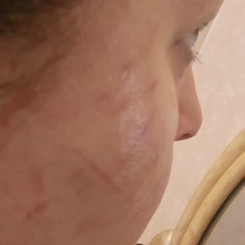 Marla Wellness Beauty Hifu Cilt Gençleştirme İşleminde Cildime Zarar Verildi!