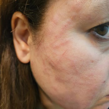 Marla Wellness Beauty Hifu Cilt Gençleştirme İşleminde Cildime Zarar Verildi!