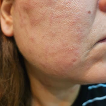 Marla Wellness Beauty Hifu Cilt Gençleştirme İşleminde Cildime Zarar Verildi!