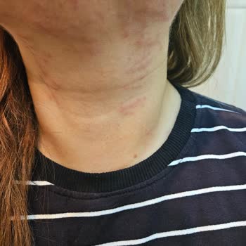 Marla Wellness Beauty Hifu Cilt Gençleştirme İşleminde Cildime Zarar Verildi!