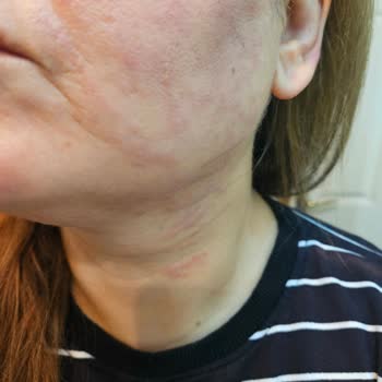 Marla Wellness Beauty Hifu Cilt Gençleştirme İşleminde Cildime Zarar Verildi!