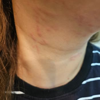 Marla Wellness Beauty Hifu Cilt Gençleştirme İşleminde Cildime Zarar Verildi!