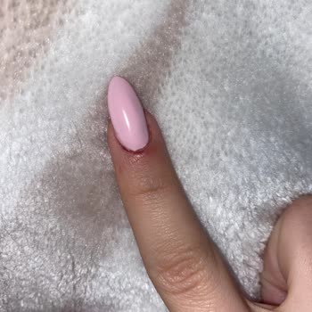 Protez Tırnakta Acı Veren Deneyim Ve Memnuniyetsizlik