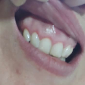 Parodontax Kullanımı Sonrası Diş Eti Sorunları