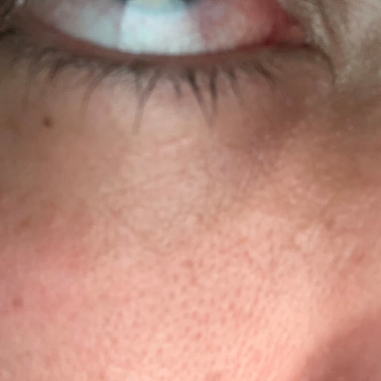 Dünya Göz Hastanesi Lazer Operasyonu Sonrası Artan Göz Sorunları