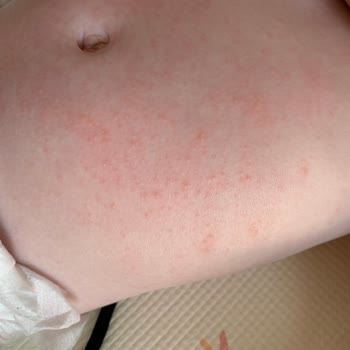 Atopik Cilt Kremi Beklenmedik Reaksiyon Yarattı