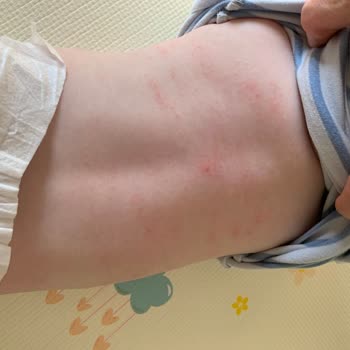 Atopik Cilt Kremi Beklenmedik Reaksiyon Yarattı