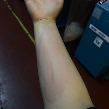 Yanlış Tedavi Sonucu Alerjik Reaksiyon