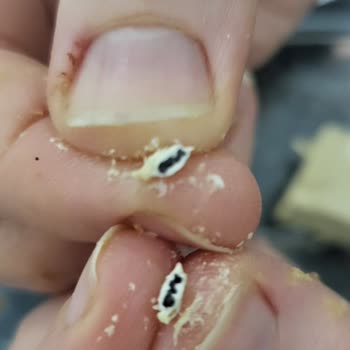 Helvada Beklenmedik Yabancı Madde Şoku