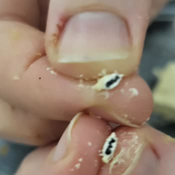 Helvada Beklenmedik Yabancı Madde Şoku