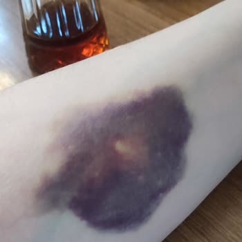 Mediplus Tıp Merkezinde Serum Uygulaması Sonrası Yaşanan Sorunlar
