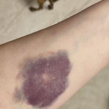 Mediplus Tıp Merkezinde Serum Uygulaması Sonrası Yaşanan Sorunlar