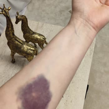 Mediplus Tıp Merkezinde Serum Uygulaması Sonrası Yaşanan Sorunlar