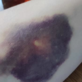Mediplus Tıp Merkezinde Serum Uygulaması Sonrası Yaşanan Sorunlar