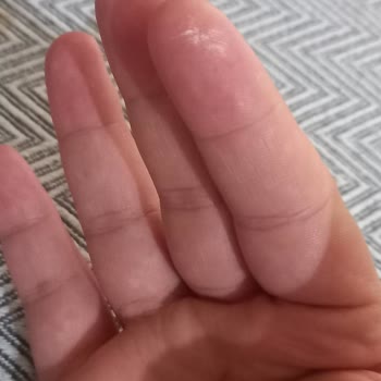 Vanish Kosla Kullanımı Sonrası Cilt Sorunu