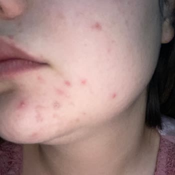 Düğün Öncesi Cilt Krizi: Yves Rocher Sebo Vegetal