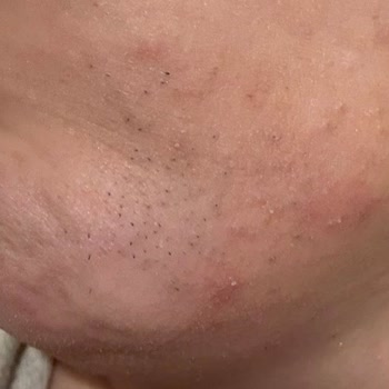 Braun FS 1000 Tüy Alma Makinesi: Beklenmedik Yan Etkiler Ve İade Sorunu