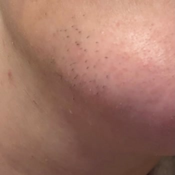 Braun FS 1000 Tüy Alma Makinesi: Beklenmedik Yan Etkiler Ve İade Sorunu