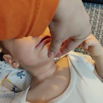 Bebek Losyonu Sonrası Ani Kızarıklık Ve Kaşıntı