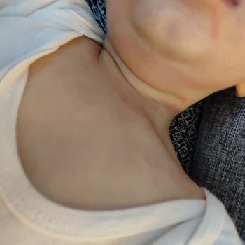 Bebek Losyonu Sonrası Ani Kızarıklık Ve Kaşıntı
