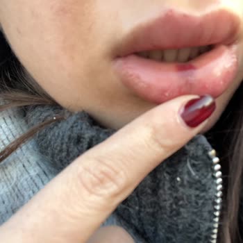 Dudak Dolgusu Deneyiminde Hayal Kırıklığı