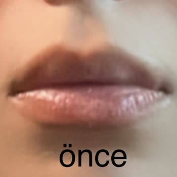 Dudak Dolgusu Deneyiminde Hayal Kırıklığı