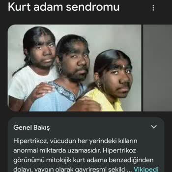 Lazer Tedavisi Yanıltıcı Tanı İle Sonuçlandı