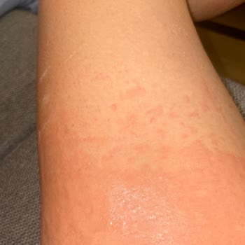 Yanlış İlaç Kullanımı Sonrası Alerjik Reaksiyon