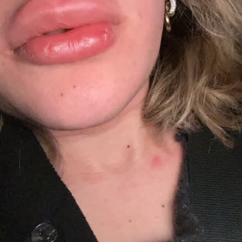 Yanlış İlaç Kullanımı Sonrası Alerjik Reaksiyon