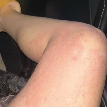 Yanlış İlaç Kullanımı Sonrası Alerjik Reaksiyon